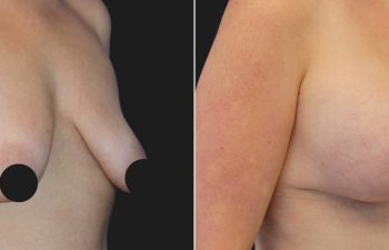 25 years old after massive weight loss, before and 3 months after breast lift with augmentation (350 CC Silicone Implants)