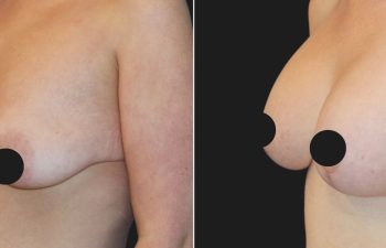 25 years old after massive weight loss, before and 3 months after breast lift with augmentation (350 CC Silicone Implants)