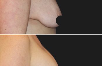 25 years old after massive weight loss, before and 3 months after breast lift with augmentation (350 CC Silicone Implants)