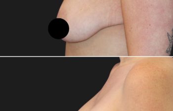 25 years old after massive weight loss, before and 3 months after breast lift with augmentation (350 CC Silicone Implants)