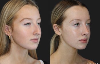 17 year-old patient before and 6 months after rhinoplasty