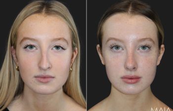 17 year-old patient before and 6 months after rhinoplasty