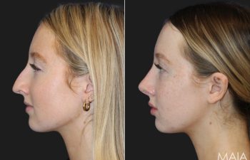 17 year-old patient before and 6 months after rhinoplasty