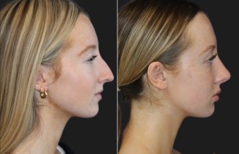 17 year-old patient before and 6 months after rhinoplasty