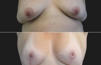 41 year-old before and 3 months after Breast Lift and Bra Roll Excision (excess skin removal and liposuction)