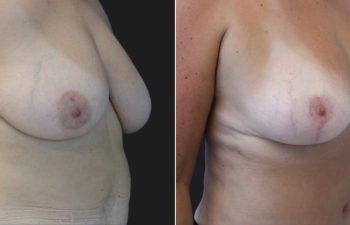 53 year-old before and 4 months after a Mommy Makeover: tummy tuck, breast lift, small breast reduction, liposuction of flanks, back, and chest