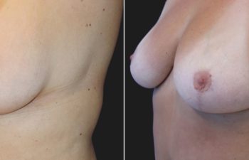 53 year-old before and 4 months after a Mommy Makeover: tummy tuck, breast lift, small breast reduction, liposuction of flanks, back, and chest