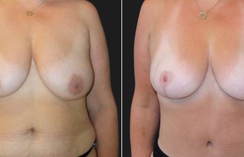 53 year-old before and 4 months after a Mommy Makeover: tummy tuck, breast lift, small breast reduction, liposuction of flanks, back, and chest