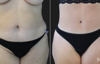 53 year-old before and 4 months after a Mommy Makeover: tummy tuck, breast lift, small breast reduction, liposuction of flanks, back, and chest