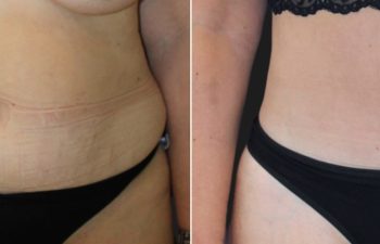 53 year-old before and 4 months after a Mommy Makeover: tummy tuck, breast lift, small breast reduction, liposuction of flanks, back, and chest