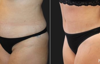 Side-by-side before and after images showing a woman's torso with noticeable reduction in abdominal fat and loose skin after a cosmetic procedure. The subject is wearing black underwear in both photos.