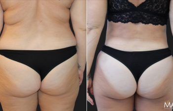 Before and after images of a person showing their back and waist area, highlighting changes in body shape. Both photos show the person wearing black undergarments.