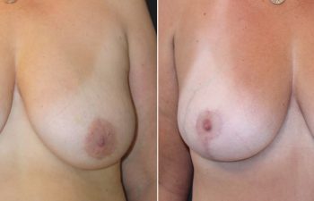 53 year-old before and 4 months after a Mommy Makeover: tummy tuck, breast lift, small breast reduction, liposuction of flanks, back, and chest