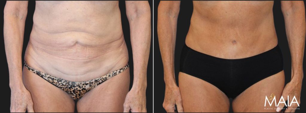 Menopause Makeover: Mid 60s patient, mother of 3, before and 4 months after extended tummy tuck, liposuction of the upper back, lower back, and flanks