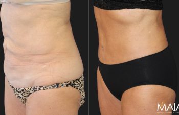 Menopause Makeover: Mid 60s patient, mother of 3, before and 4 months after extended tummy tuck, liposuction of the upper back, lower back, and flanks