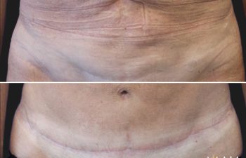 Menopause Makeover: Mid 60s patient, mother of 3, before and 4 months after extended tummy tuck, liposuction of the upper back, lower back, and flanks