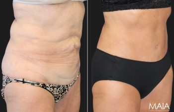 Menopause Makeover: Mid 60s patient, mother of 3, before and 4 months after extended tummy tuck, liposuction of the upper back, lower back, and flanks