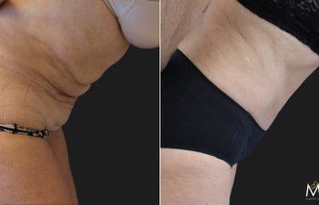 Menopause Makeover: Mid 60s patient, mother of 3, before and 4 months after extended tummy tuck, liposuction of the upper back, lower back, and flanks