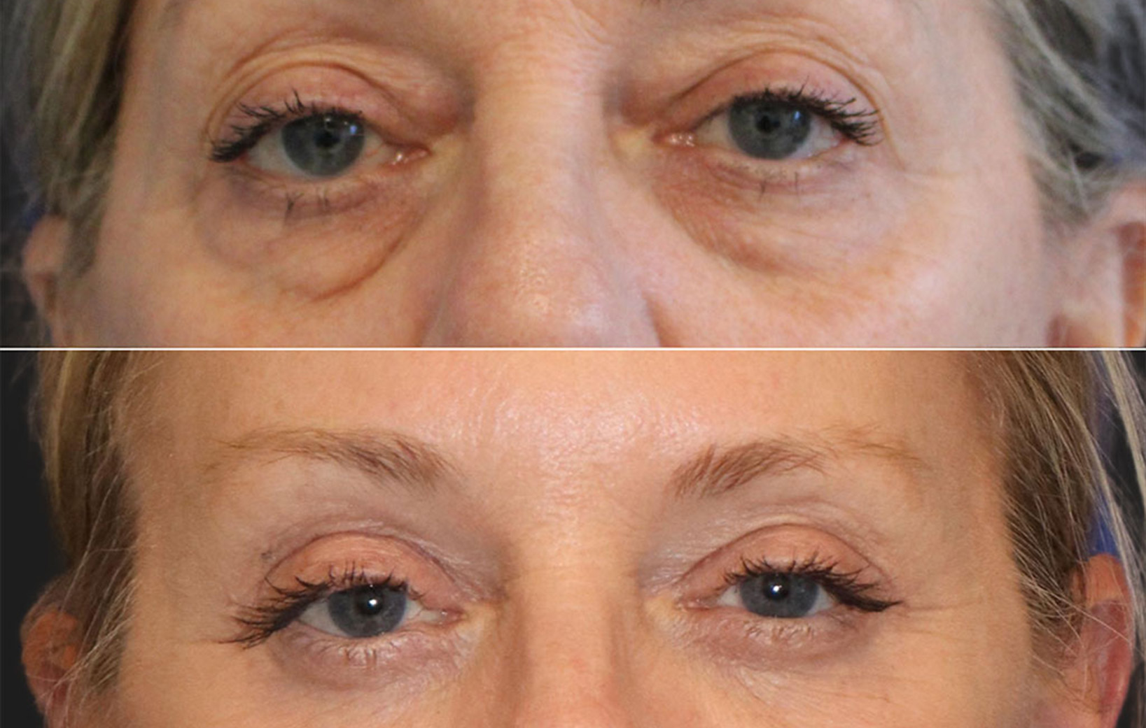 61 year-old patient before and after upper and lower blepharoplasty, brow lift, fat grating, and TCA peel