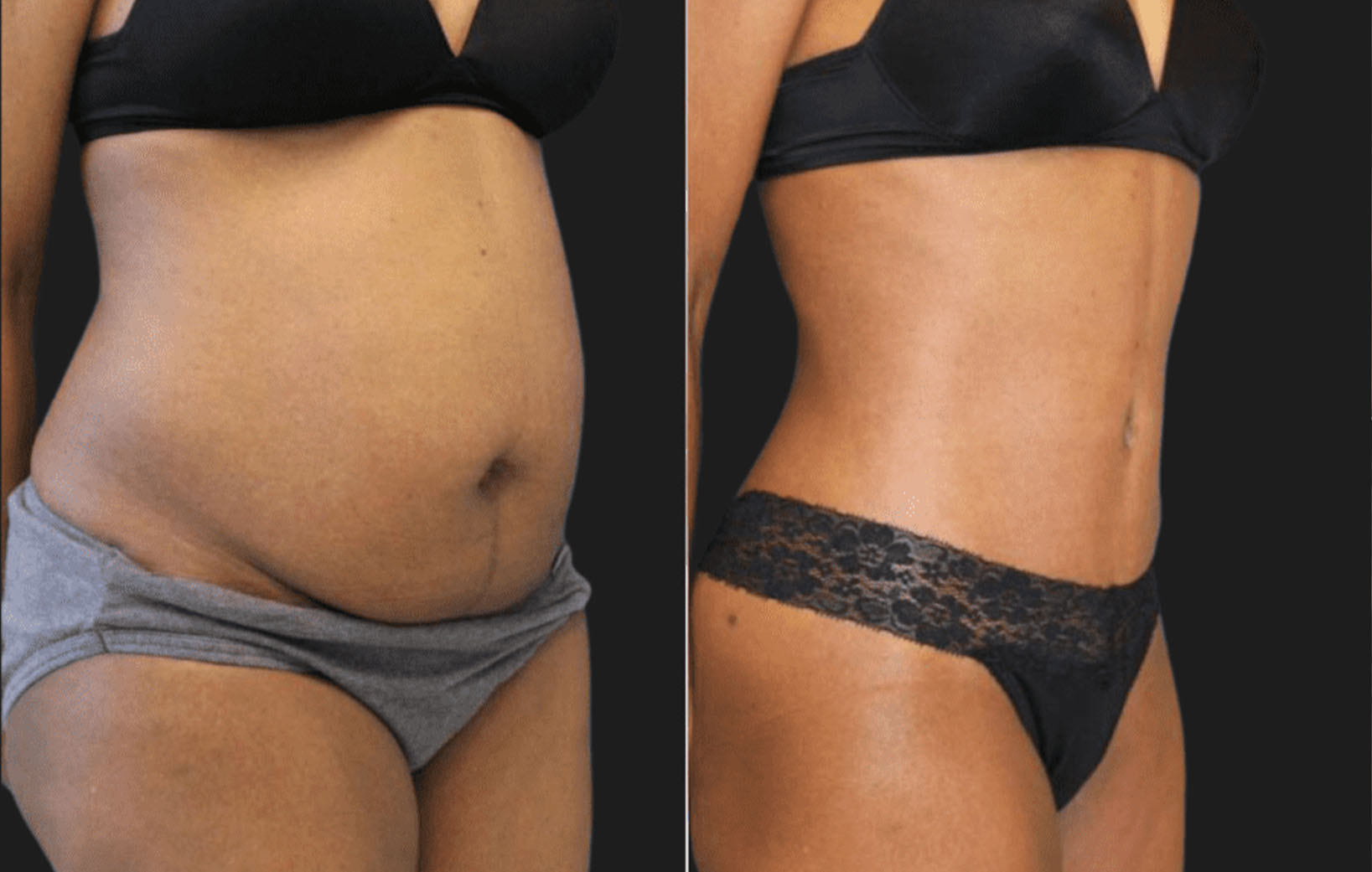 53 year-old patient before and after abdominoplasty and flanks liposuction