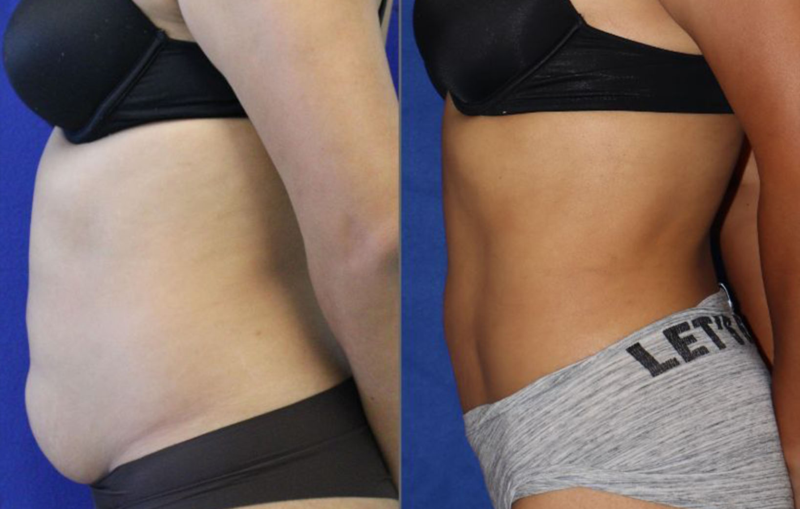 29 year-old before and after liposuction of the abdomen