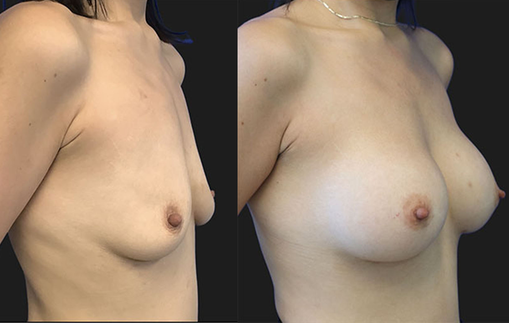 30 year-old patient before and after breast augmentation