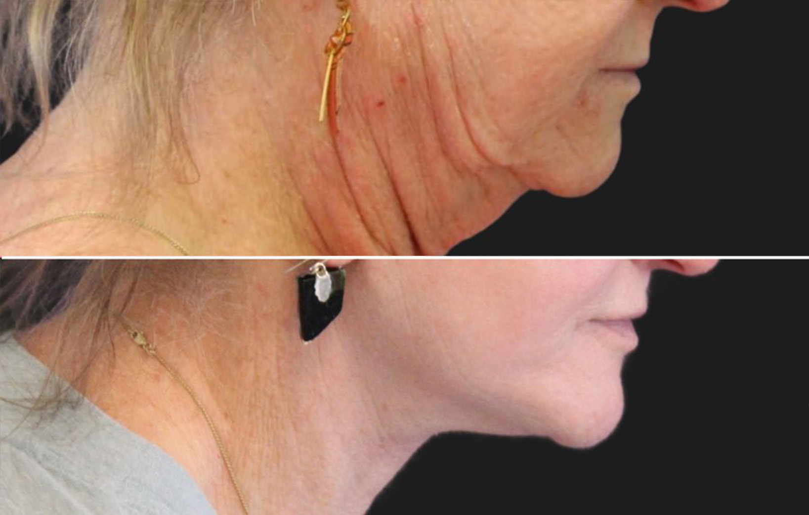 70 year-old patient before and after facelift, neck lift, fat grafting, lip lift and CO2 laser