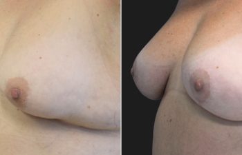 41 year-old before and 3 months after Breast Lift and Bra Roll Excision (excess skin removal and liposuction)