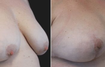 41 year-old before and 3 months after Breast Lift and Bra Roll Excision (excess skin removal and liposuction)