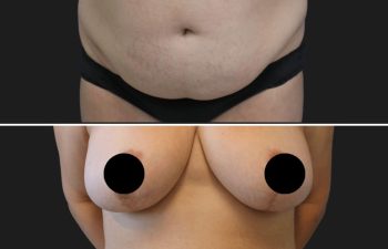 27 year-old before and 6 months after 360 Liposuction and Breast Reduction