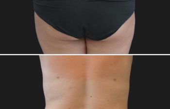 27 year-old before and 6 months after 360 Liposuction and Breast Reduction