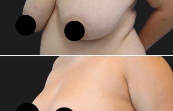 27 year-old before and 6 months after 360 Liposuction and Breast Reduction