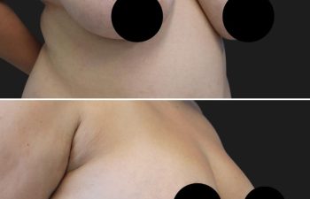 27 year-old before and 6 months after 360 Liposuction and Breast Reduction