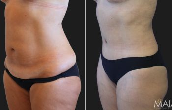 48 Year-Old Mother Before and 3 Months After an Extended Tummy Tuck and Flank Liposuction.