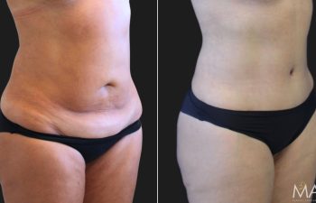 48 Year-Old Mother Before and 3 Months After an Extended Tummy Tuck and Flank Liposuction.