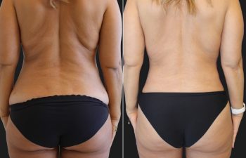 48 Year-Old Mother Before and 3 Months After an Extended Tummy Tuck and Flank Liposuction.