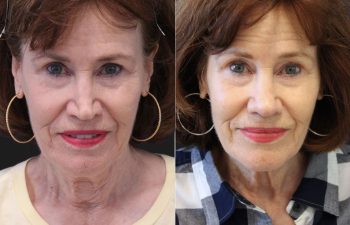 71 year-old patient before and 6 Weeks After Revision Rhinoplasty - Collapsed Valve Repair. Final Results Expected in 1 Year.