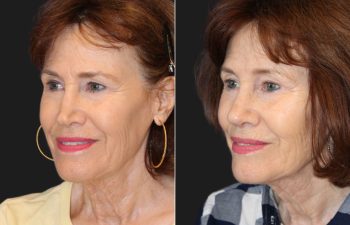 71 year-old patient before and 6 Weeks After Revision Rhinoplasty - Collapsed Valve Repair. Final Results Expected in 1 Year.