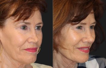 71 year-old patient before and 6 Weeks After Revision Rhinoplasty - Collapsed Valve Repair. Final Results Expected in 1 Year.