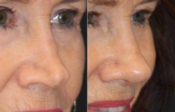 71 year-old patient before and 6 Weeks After Revision Rhinoplasty - Collapsed Valve Repair. Final Results Expected in 1 Year.