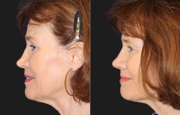 71 year-old patient before and 6 Weeks After Revision Rhinoplasty - Collapsed Valve Repair. Final Results Expected in 1 Year.