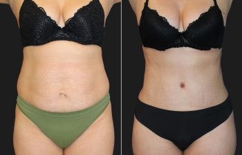 41 Year-Old Before And 2 Months After A Tummy Tuck With Flank Liposuction