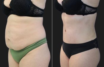 41 Year-Old Before And 2 Months After A Tummy Tuck With Flank Liposuction