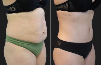 41 Year-Old Before And 2 Months After A Tummy Tuck With Flank Liposuction