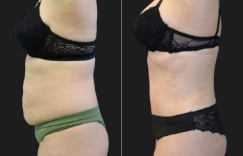 41 Year-Old Before And 2 Months After A Tummy Tuck With Flank Liposuction