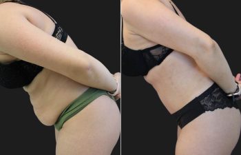 41 Year-Old Before And 2 Months After A Tummy Tuck With Flank Liposuction