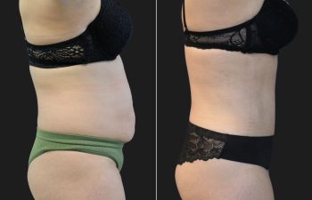 41 Year-Old Before And 2 Months After A Tummy Tuck With Flank Liposuction