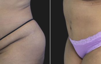 46 Year Old Before and 6 Months After An Extended Abdominoplasty and Liposuction of Flanks & Lateral Chest.