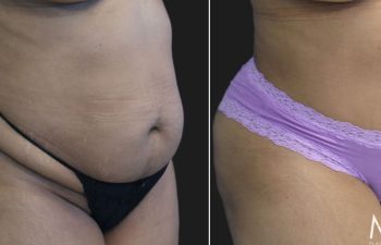 46 Year Old Before and 6 Months After An Extended Abdominoplasty and Liposuction of Flanks & Lateral Chest.