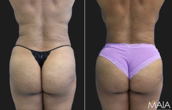 46 Year Old Before and 6 Months After An Extended Abdominoplasty and Liposuction of Flanks & Lateral Chest.